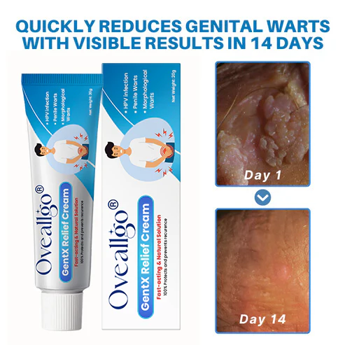 Oveallgo® HPV Genital Warts Relief Cream